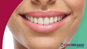 blanqueamiento dental antes y despues